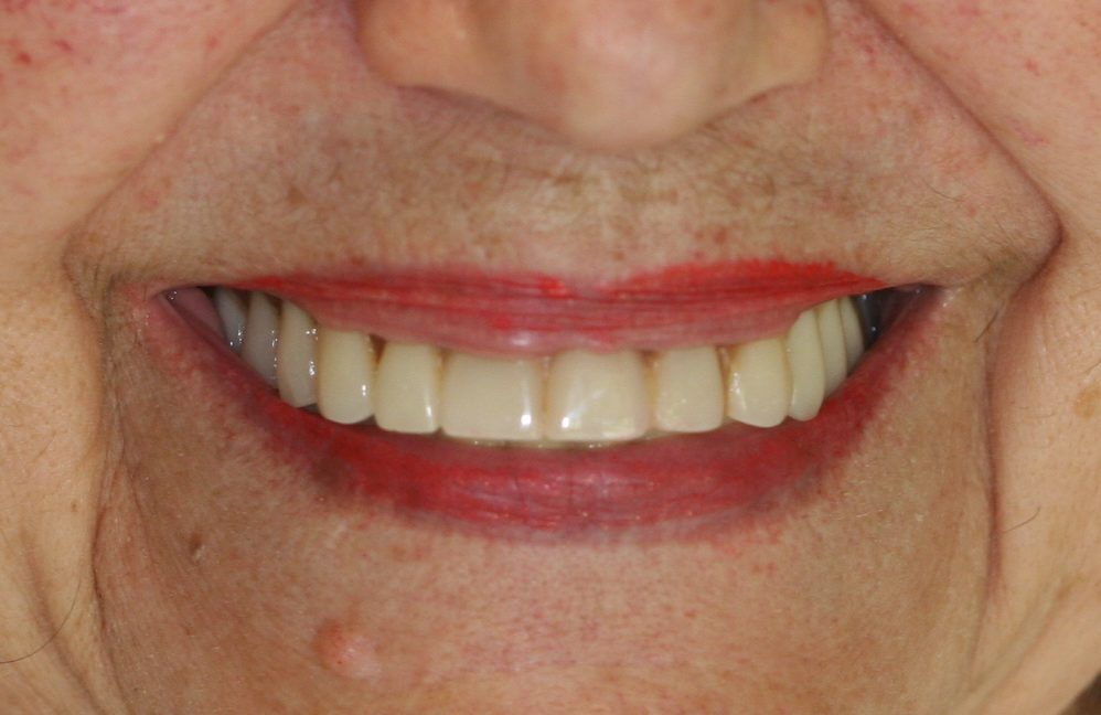 dental patient after 13