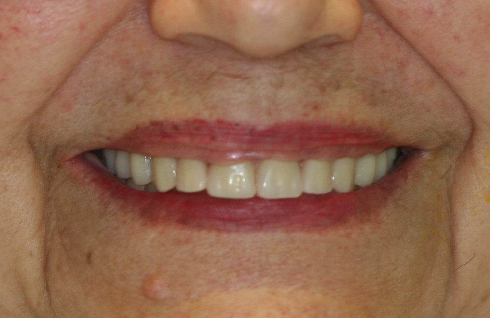 dental patient before 13
