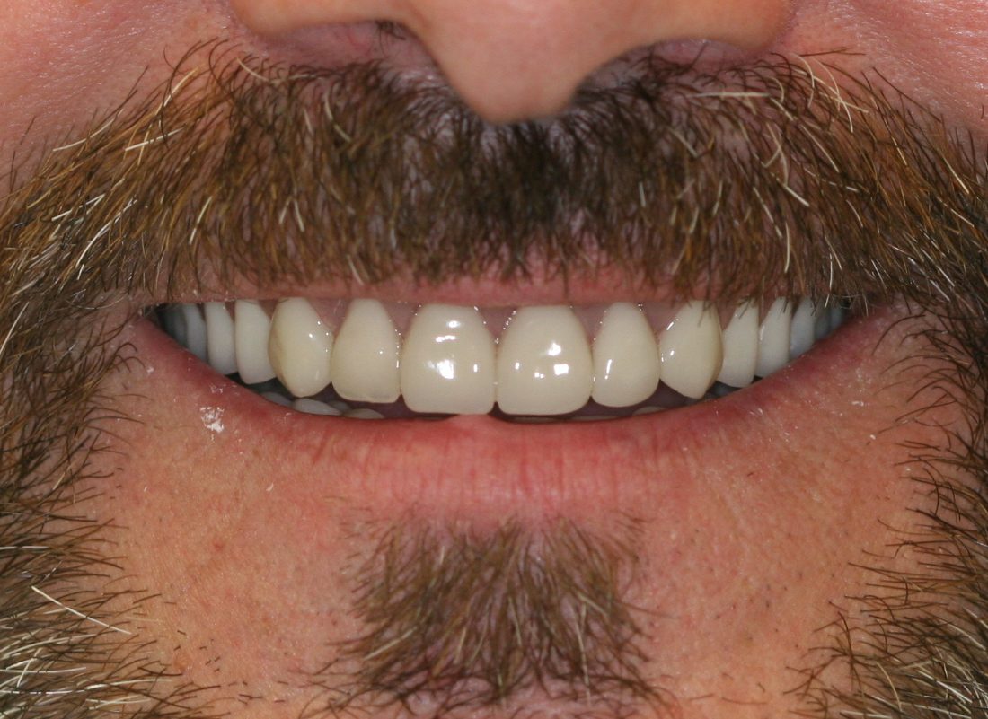 dental patient after 11