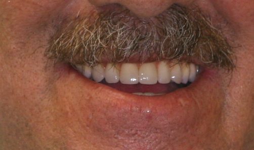 dental patient after 12