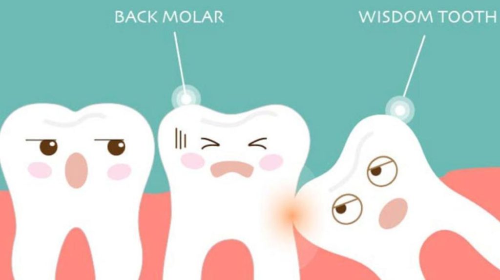 normal wisdom teeth growth