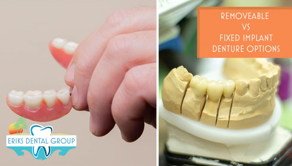 fixed implant dentures