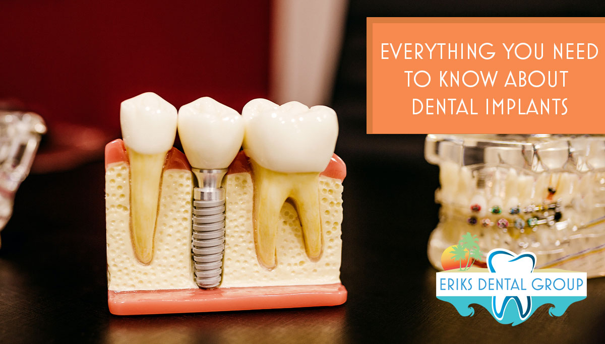 What You Should Know Before Getting Dental Implants