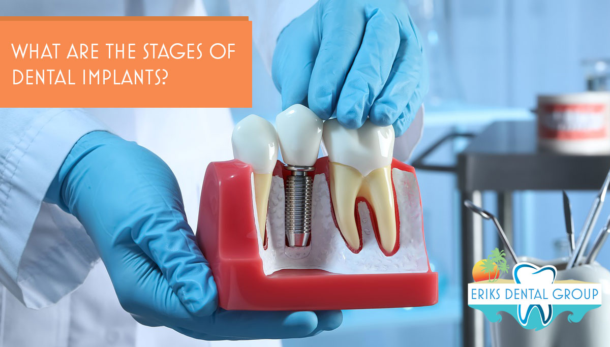 Understanding The Stages Of Dental Implant Surgery