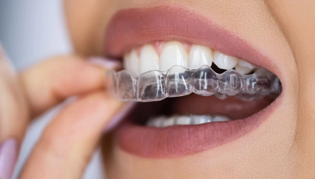 Woman placing the mouth guard in her mouth
