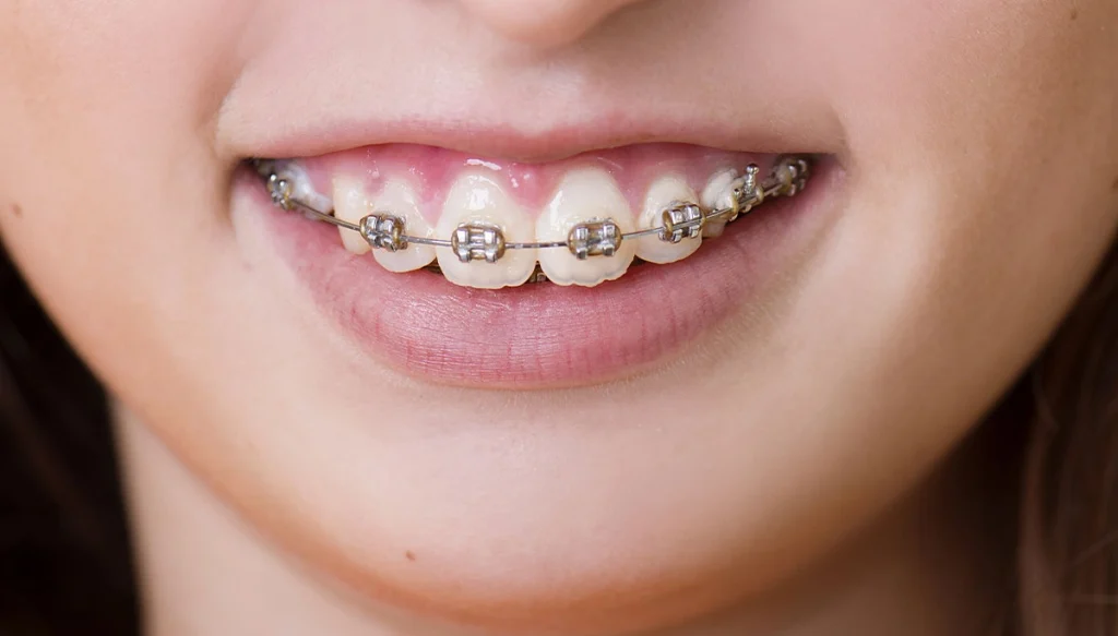 closeup of teenage girl wearing braces while smilng